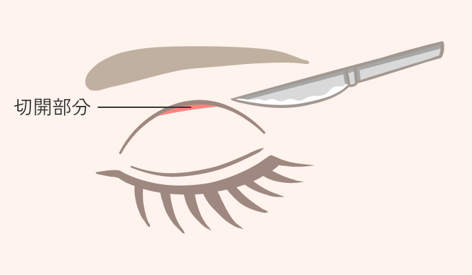 部分切開