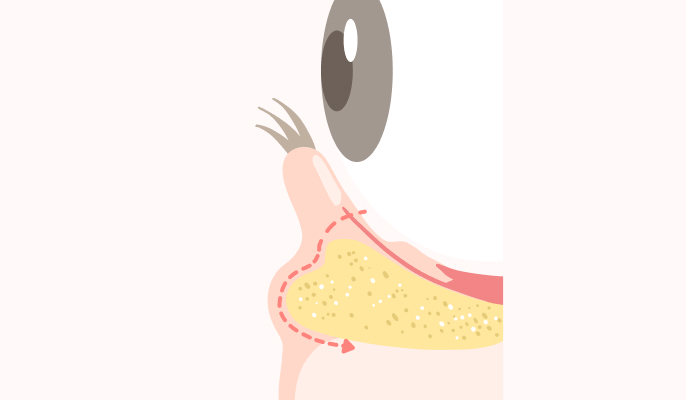 下眼瞼脱脂の説明1