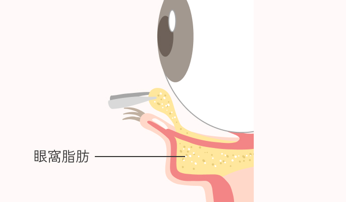 下眼瞼脱脂の説明2