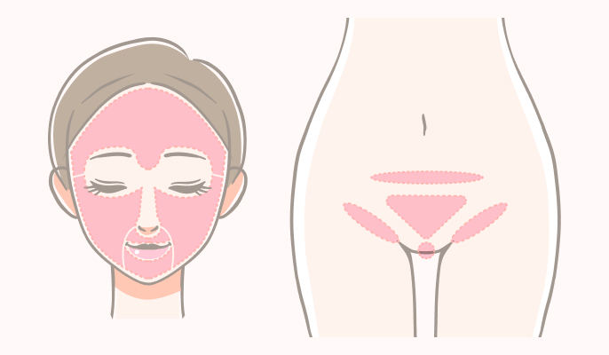 顔+VIO脱毛プラン