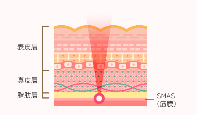 ウルトラセルQプラスの施術説明