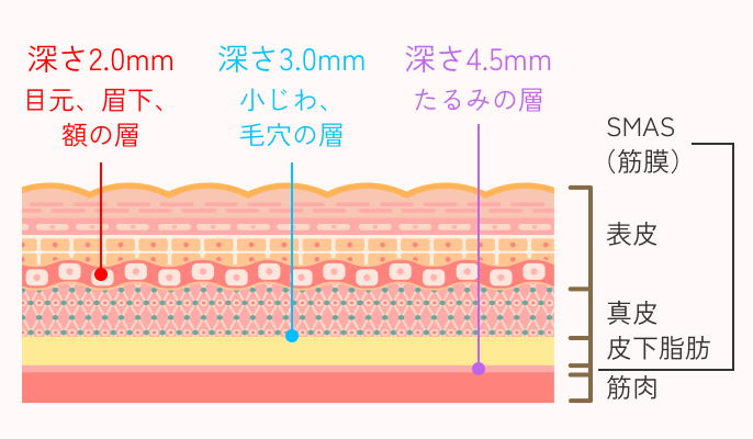 ソノクイーンの施術説明