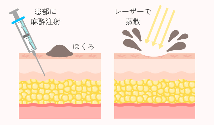 炭酸ガスレーザーの施術説明