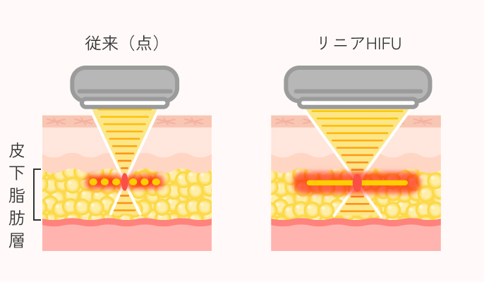 リニアHIFUの施術説明