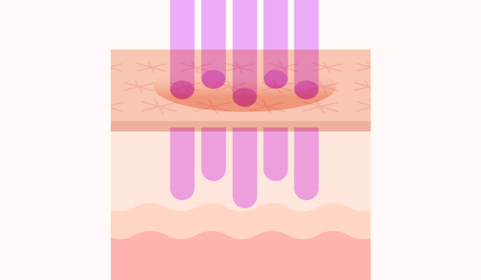 フラクショナルレーザーの施術説明1