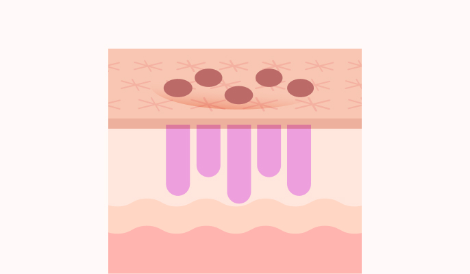 フラクショナルレーザーの施術説明2