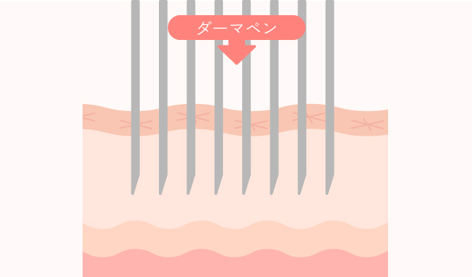 ダーマペンの施術詳細1