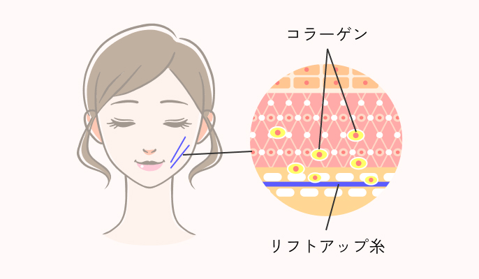 スレッドリフトの施術説明