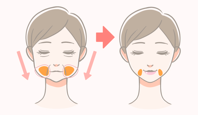 ジョールファット除去の施術説明