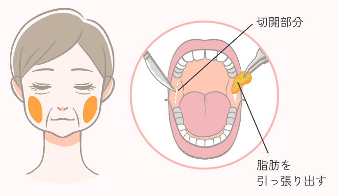 バッカルファット除去の施術説明