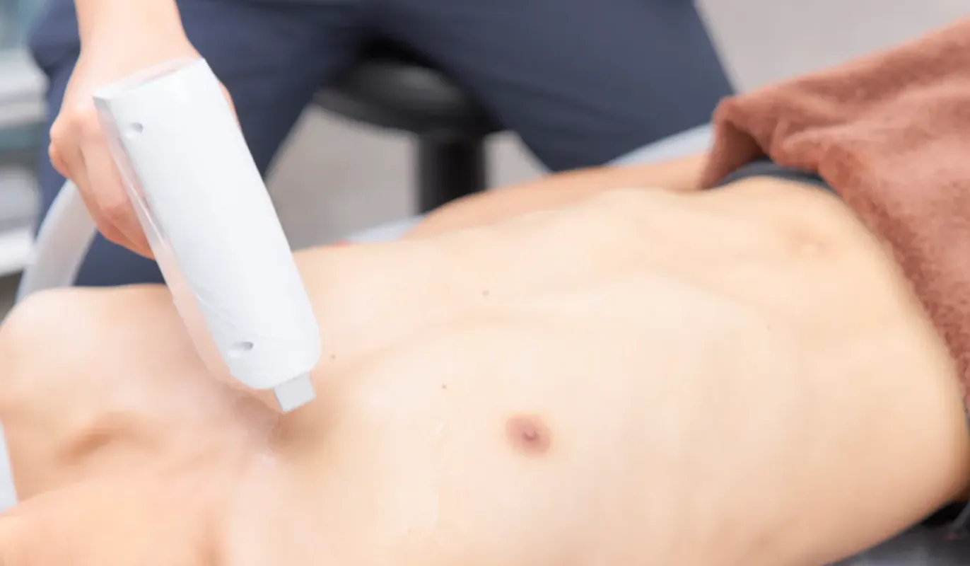 メンズ脱毛施術