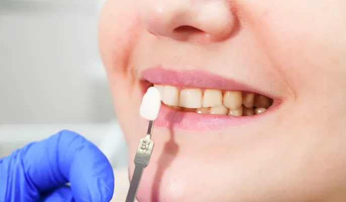 セラミック板の接着