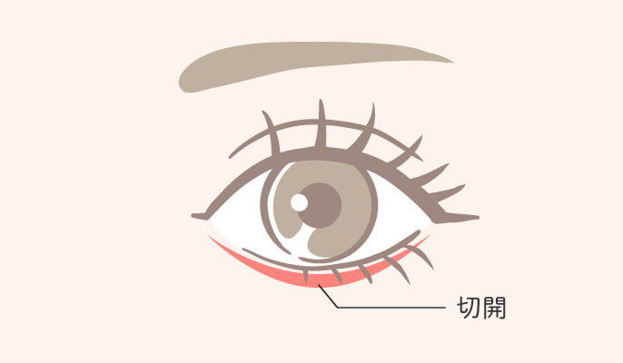 表ハムラ法の説明1