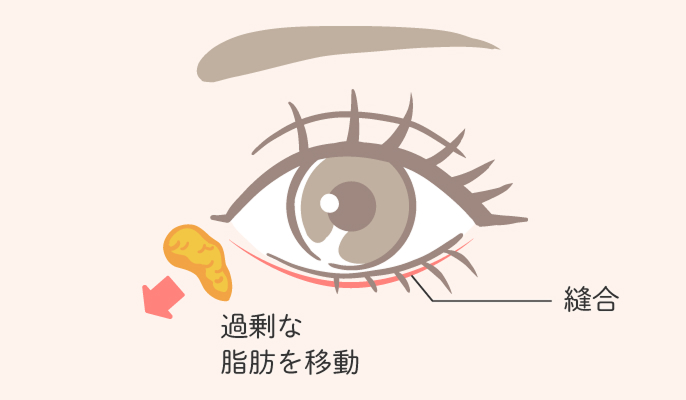 表ハムラ法の説明2