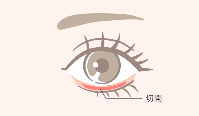 裏ハムラ法の説明1