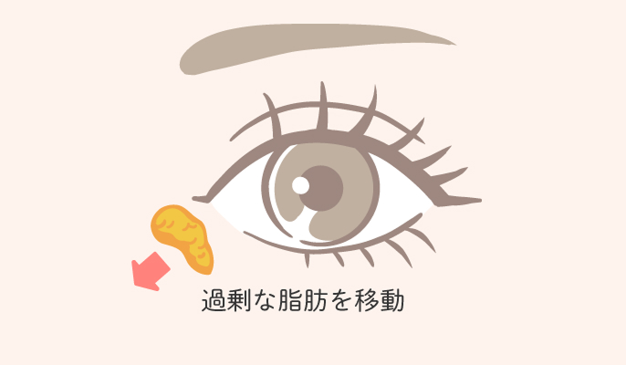 裏ハムラ法の説明2