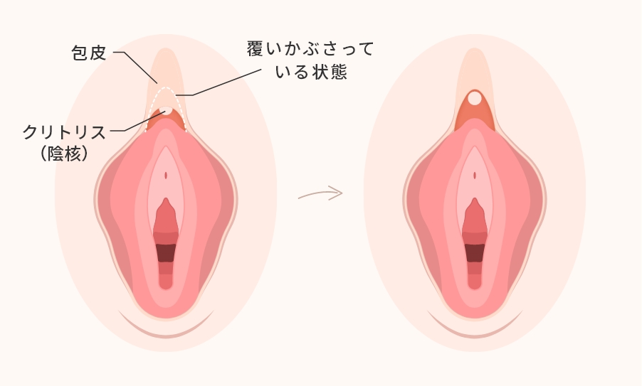 クリトリス包茎手術とは