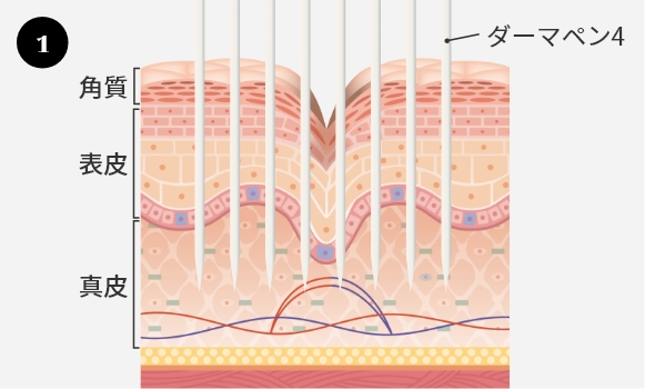肌の表面に微細な穴をあける