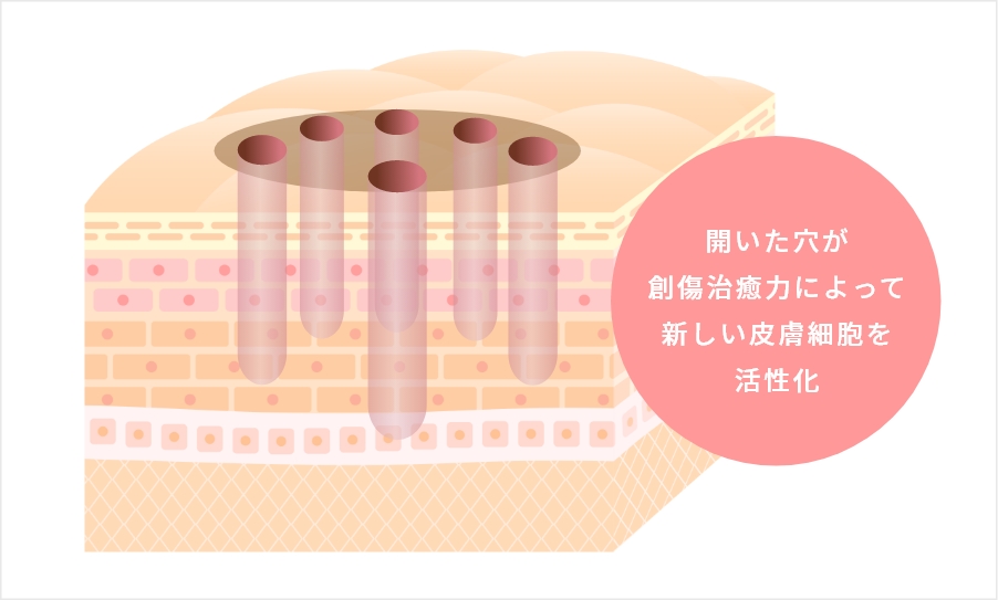フラクショナルレーザーとは