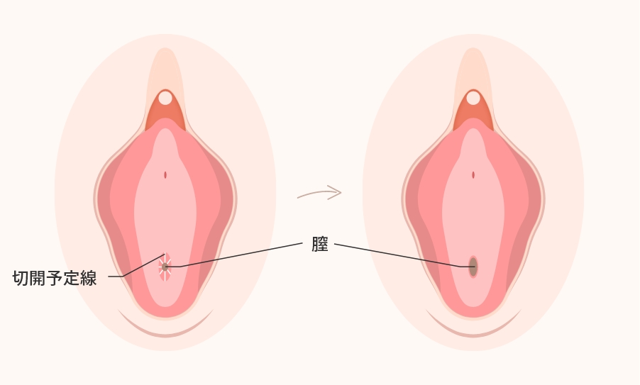 処女膜切開とは