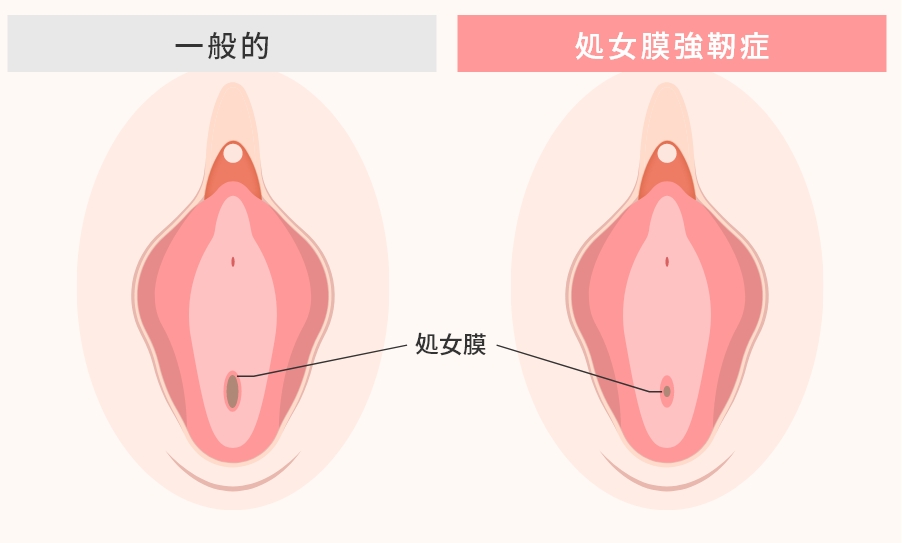 処女膜強靭症とは