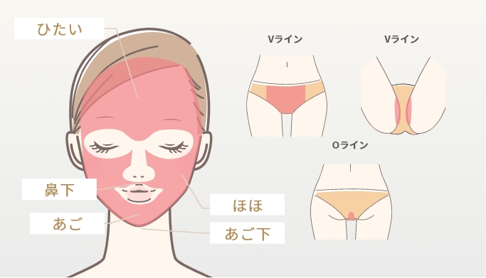 顔+VIO脱毛プラン