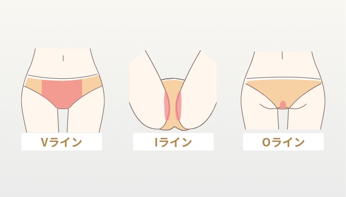 VIOの医療脱毛