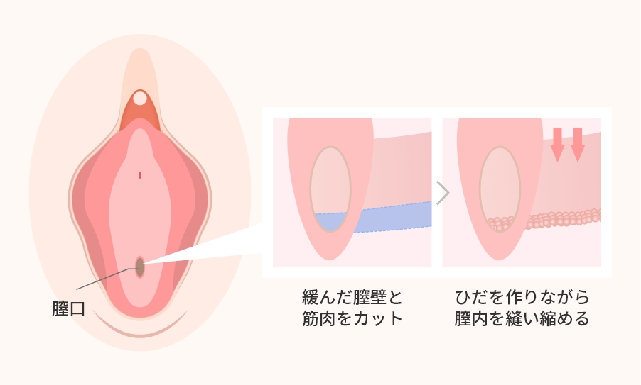 膣縮小手術とは